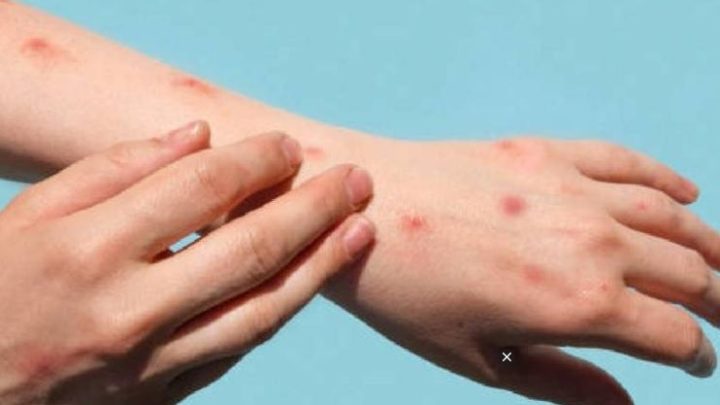 Viruela del mono: México abre centro de información por la viruela símica