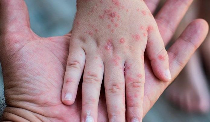 Secretaría de Salud da a conocer medidas preventivas contra la viruela símica.