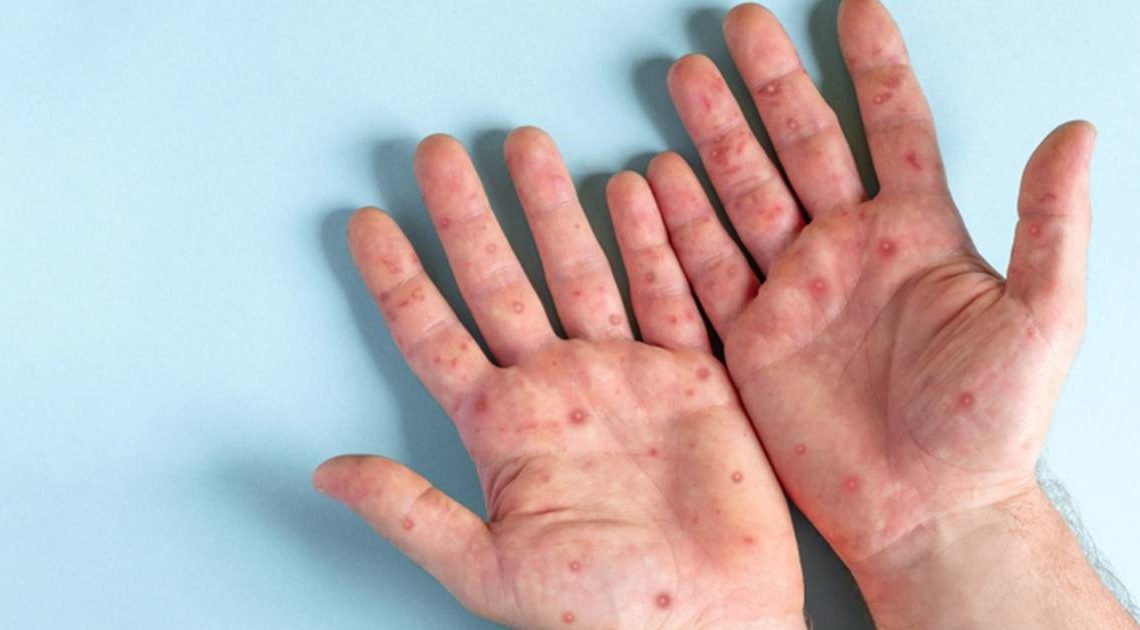 Viruela del mono: México acumula 504 casos de la enfermedad; CDMX, con más contagios