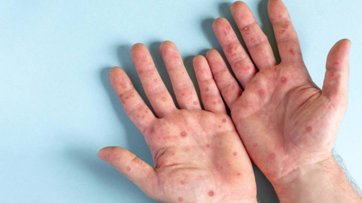 Viruela del mono: México acumula 504 casos de la enfermedad; CDMX, con más contagios