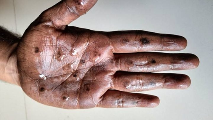 Casos de viruela del mono en el mundo disminuyeron en última semana: OMS