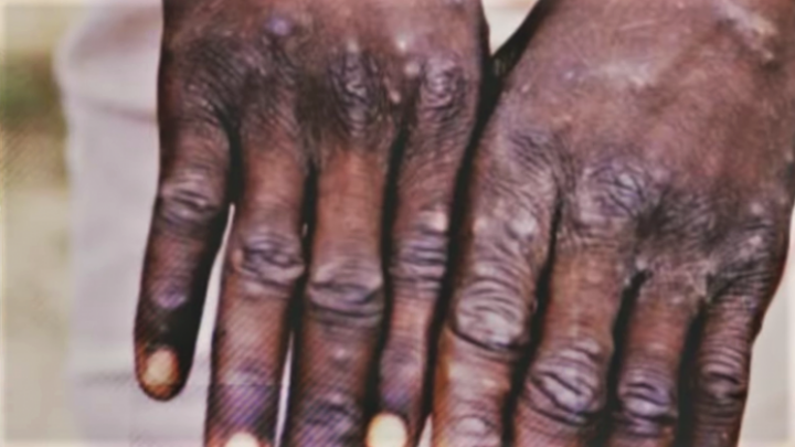 Aumenta a nueve los casos confirmados de viruela del mono en Honduras