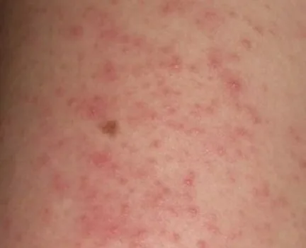 La valoración médica es relevante para cualquier tipo de dermatitis
