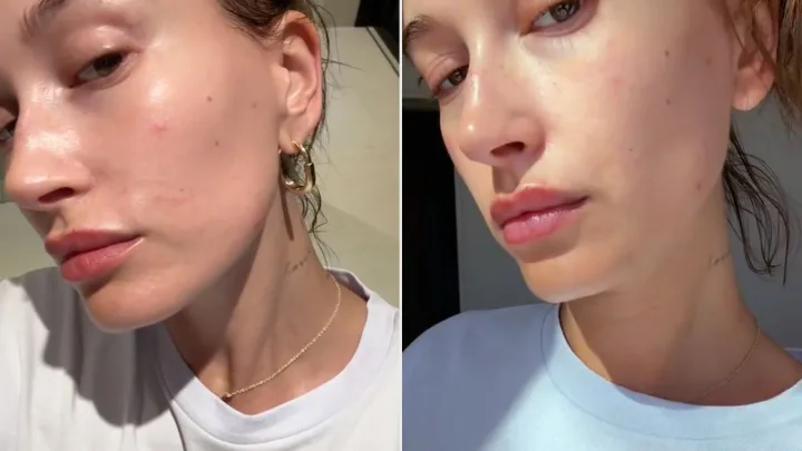  Hailey Bieber habla sobre su lucha contra la dermatitis perioral