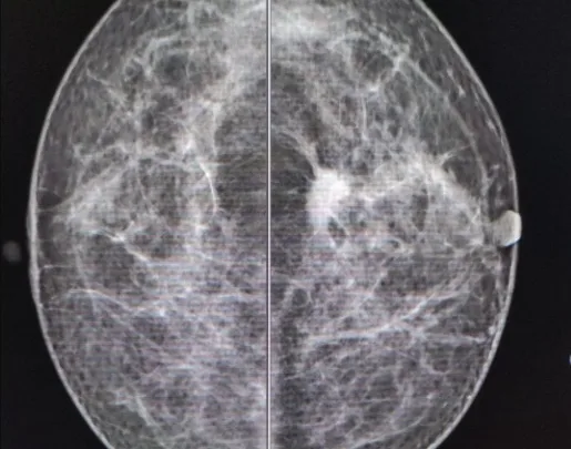 Recomienda la Secretaría de Salud acciones para detección oportuna del Cáncer de Mama