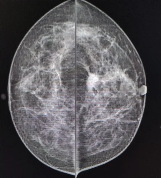 Recomienda la Secretaría de Salud acciones para detección oportuna del Cáncer de Mama