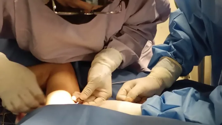 Instala SESA quinto Catéter Subcutáneo totalmente implantado