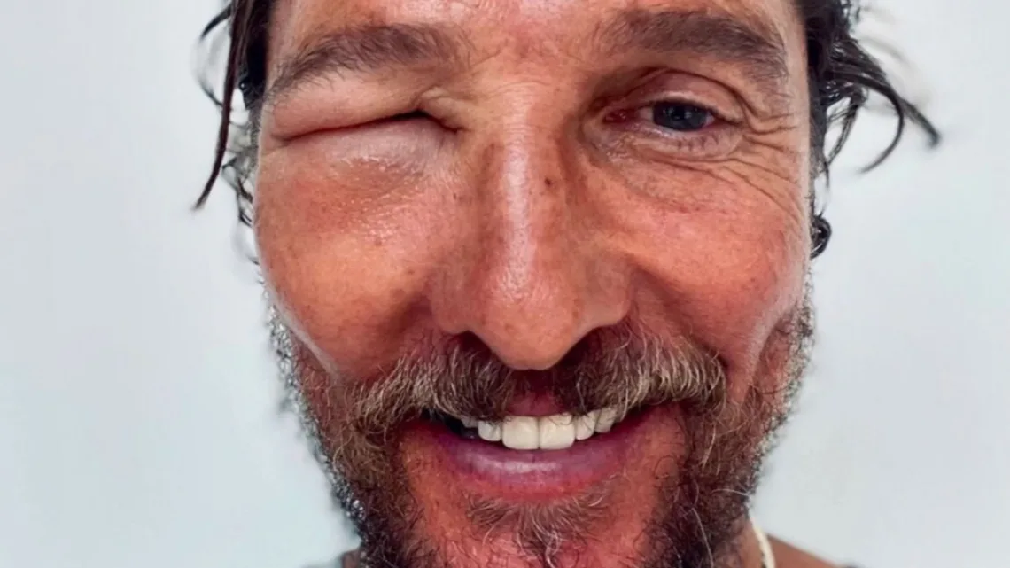 Matthew McConaughey sufre grave reacción por picadura de abeja