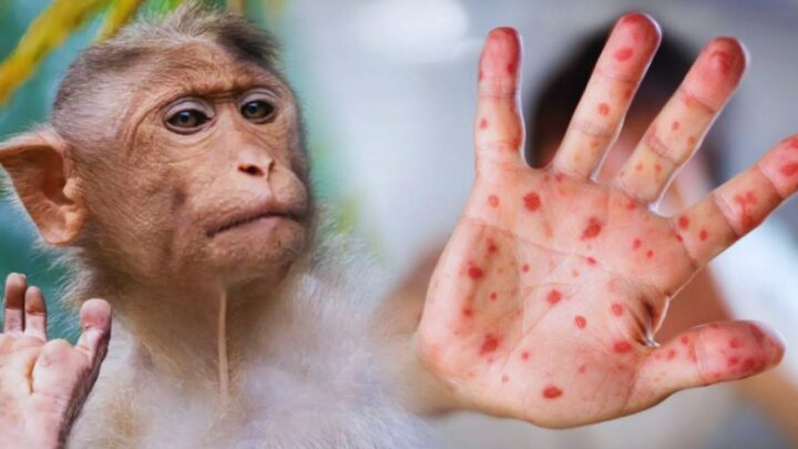 Lleva a cabo SESA vigilancia epidemiológica de mpox