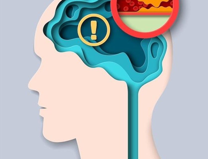 SESA llama a la prevención y detección oportuna del Ictus SESA llama a la prevención y detección oportuna del Ictus