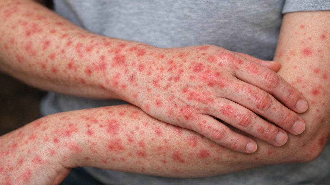 Aunque el diagnóstico de sarampión deje de estar en el cuerpo, este deja su huella; estos son algunos de los síntomas